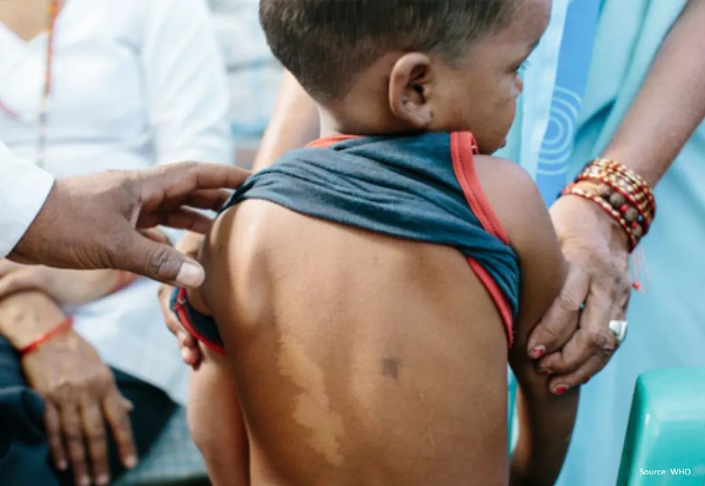 Kasus Kusta Anak di Maluku Utara Masih Tinggi, Dinkes Perkuat Deteksi Dini Menuju Eliminasi 2030